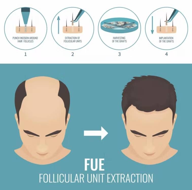 FUE Hair Implant Micro Motor H - огляд і ціна Hair Care Vegan